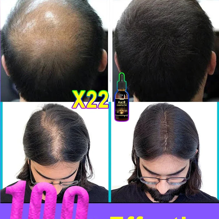 100% NATURAL ANTI HAIR LOSS PRODUCT - UNISEX