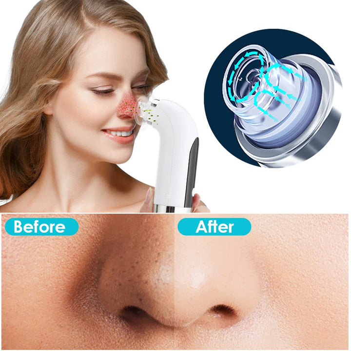 SMALL ELECTRIC REMOVER FOR Pimples, Blackheads, Acnes...